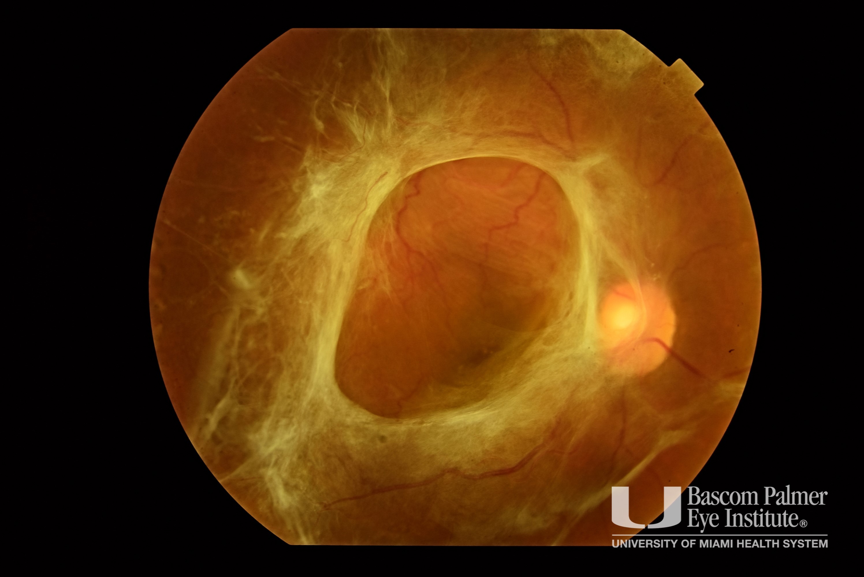 TR071620OI Tractional Retinal Detachment From Proliferative Diabetic Retinopathy